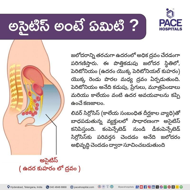 అసైటిస్  అంటే ఏమిటి? | What is Ascites in Telugu | ఏది అసిటిస్‌కు కారణమవుతుంది | అసిటిస్ వ్యాధి అంటే ఏమిటి | అసైటిస్ అర్థం | హైదరాబాద్‌లో అసిటిస్ చికిత్స