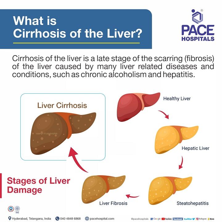 what is cirrhosis of the liver | what causes cirrhosis of the liver | Liver Cirrhosis in India | what is liver cirrhosis | liver cirrhosis meaning | liver cirrhosis definition | define cirrhosis