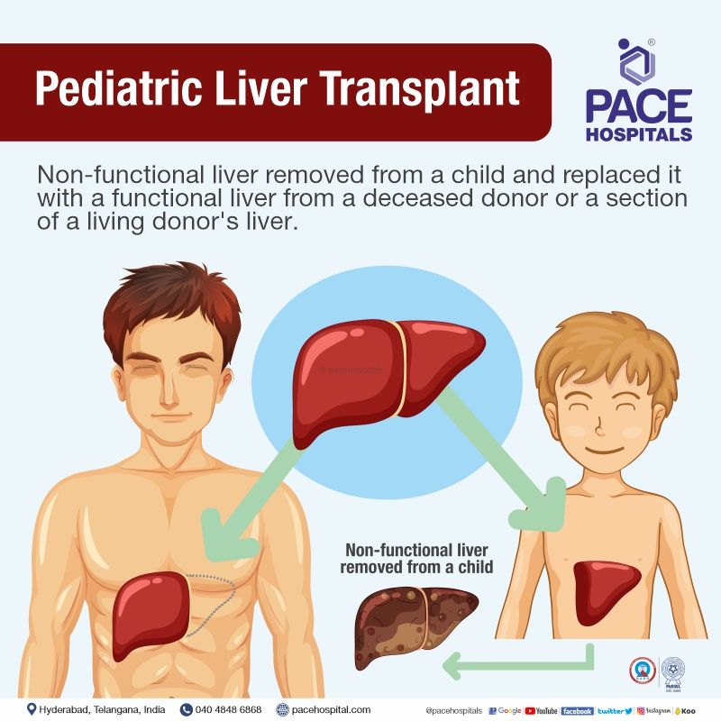 what is pediatric liver transplant | childrens liver transplantation in India | paediatric liver transplant in hyderabad, telangana