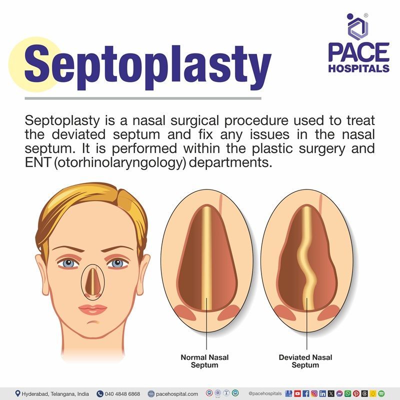 septoplasty meaning | septoplasty surgery cost in Hyderabad | best septoplasty treatment in Hyderabad | septoplasty treatment near me | top septoplasty procedure hospital in Hyderabad, India