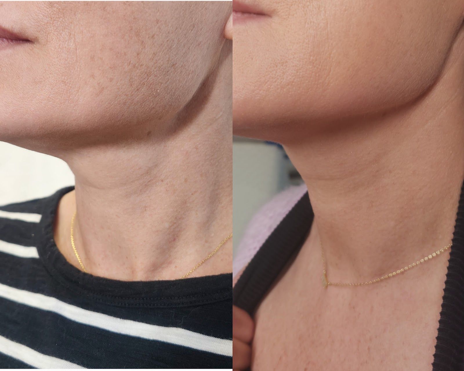 Side-by-side comparison of a person's neck and jawline; before and after a treatment. Skin appears smoother in the after photo.