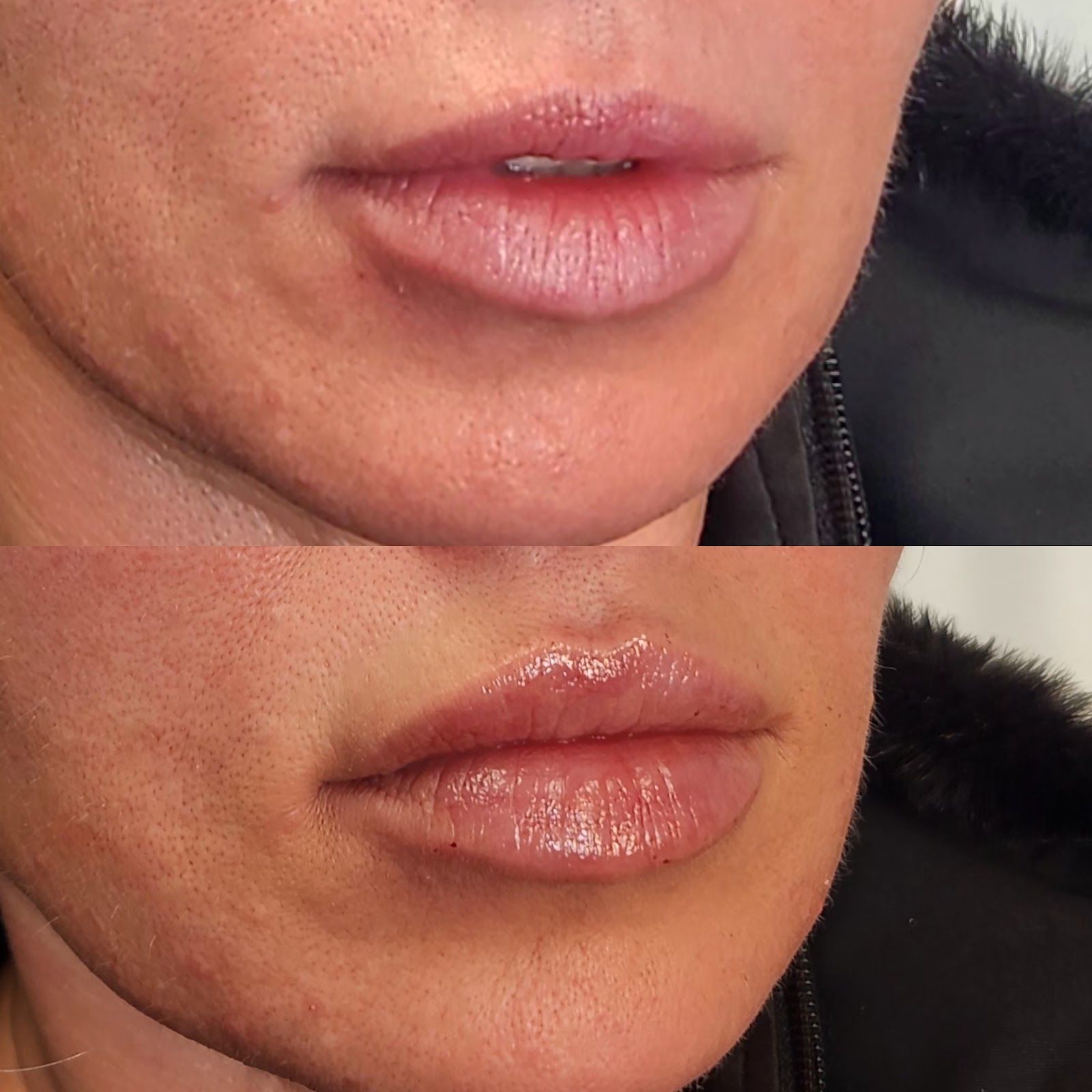 Two photos show a person's lips before and after lip filler treatment; the after photo shows fuller, plumper lips.