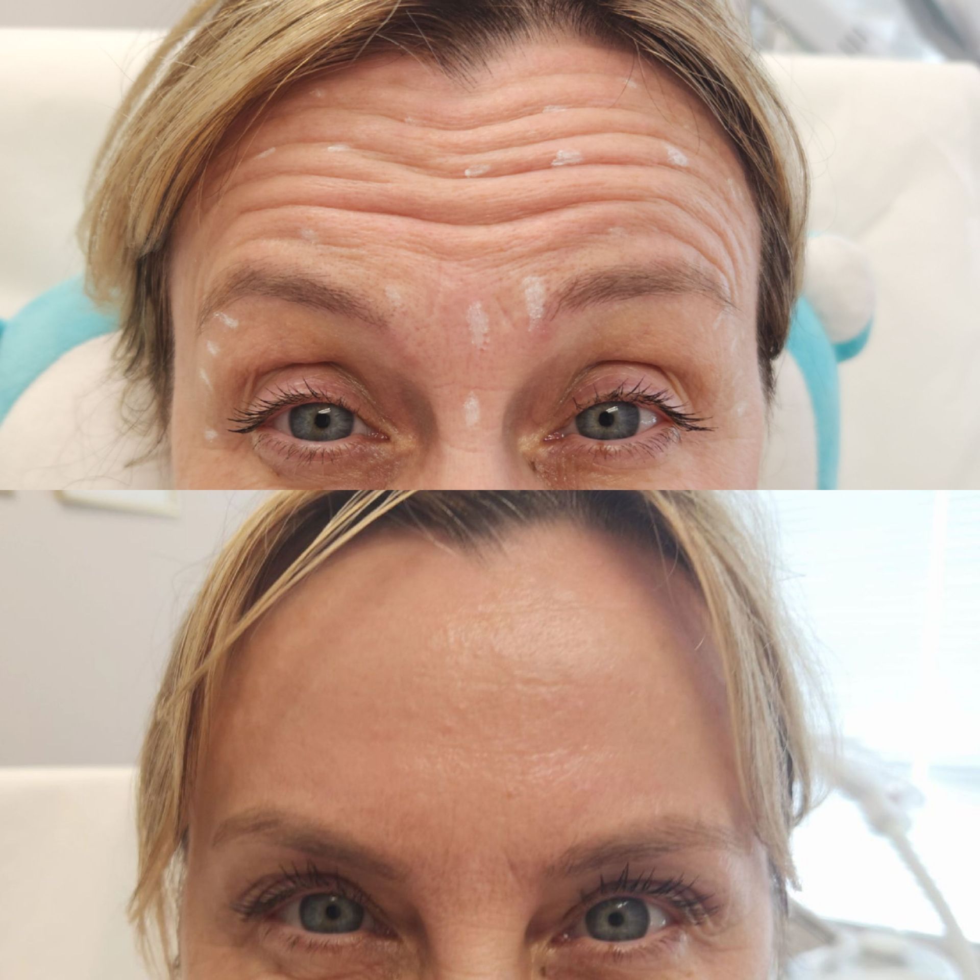 A before and after photo of a woman 's forehead.
