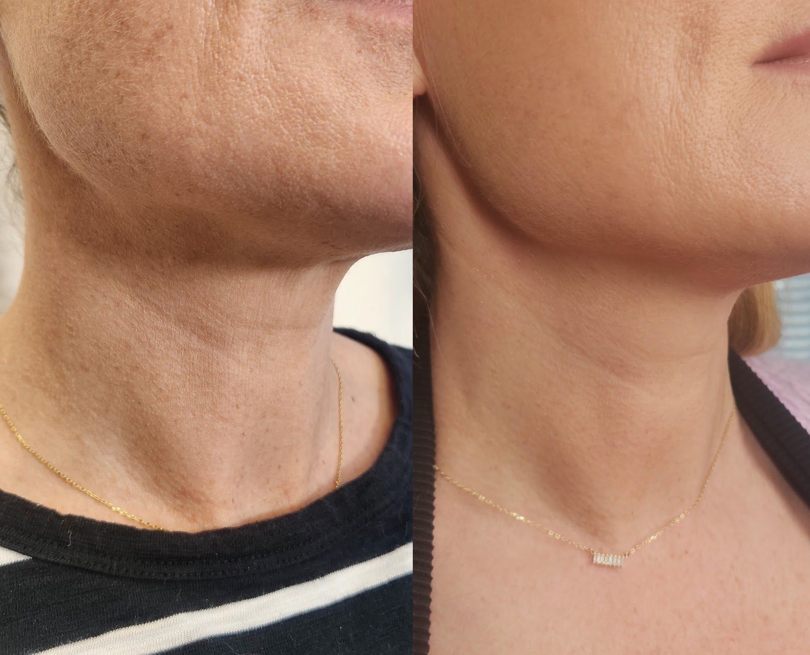 Side-by-side comparison of a neck; left side has wrinkles, right side is smoother.