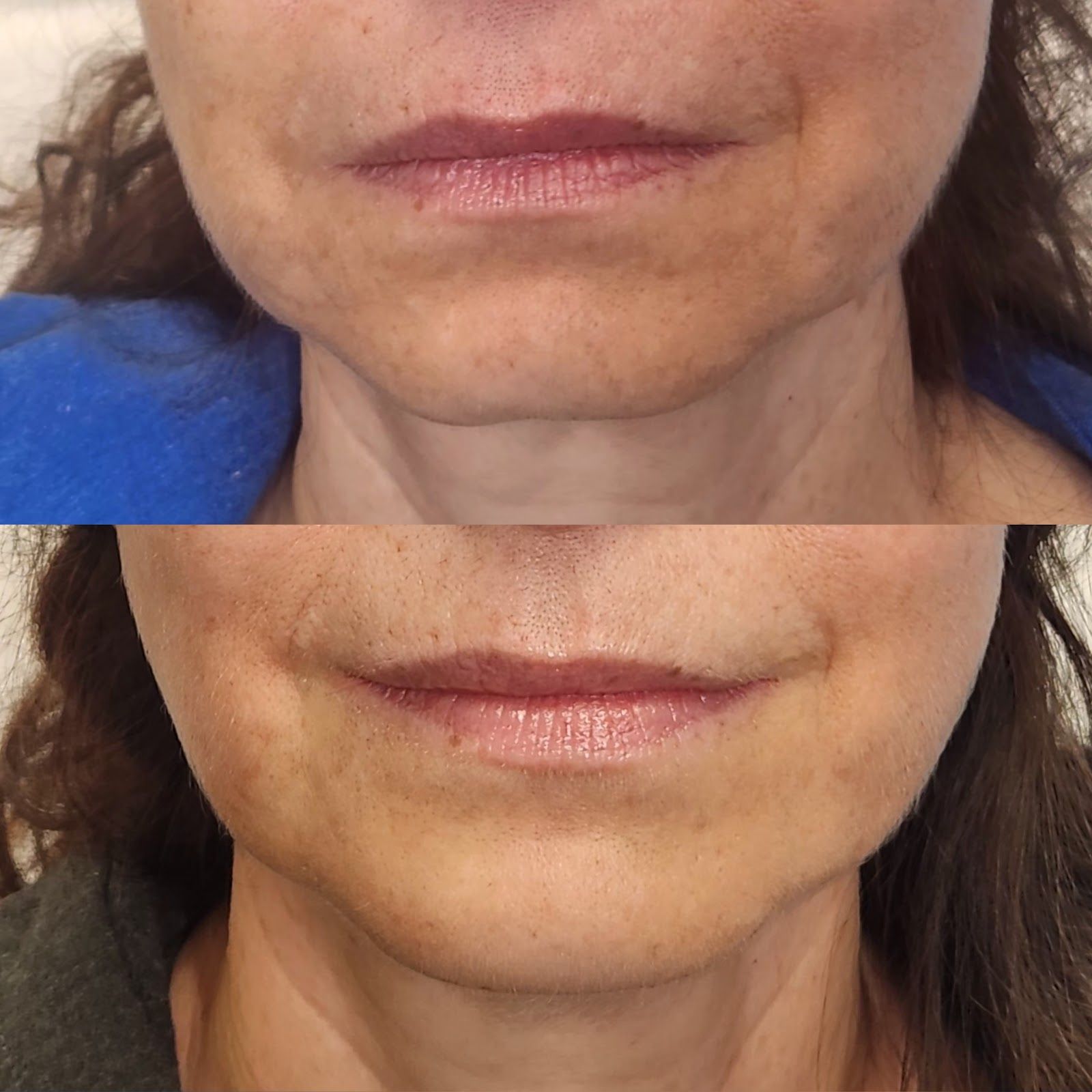 Side-by-side comparison: Before and after treatment of a person's lower face/chin, showing improved skin texture.