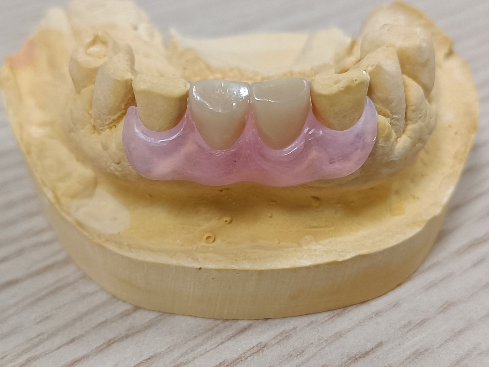 Protesi in nylon flessibili