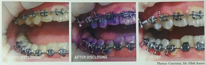 Orthodontics | Brisbane, QLD | Carina Dental Practice