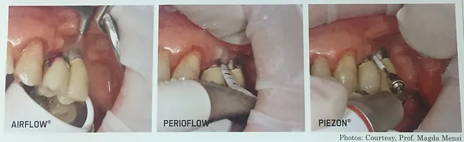 Peri-Implantitis | Brisbane, QLD | Carina Dental Practice