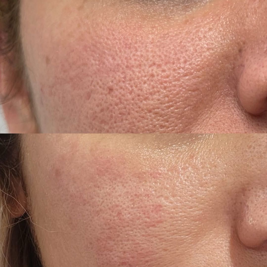 A Before and After Photo of a Woman 's Face With a Lot of Pores — SKN Gold Coast in Southport, QLD