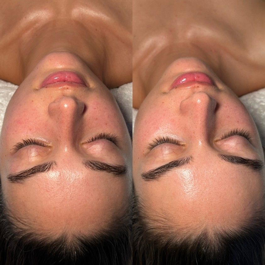 Before and After Image of a Woman Getting a Facial Treatment — SKN Gold Coast in Southport, QLD