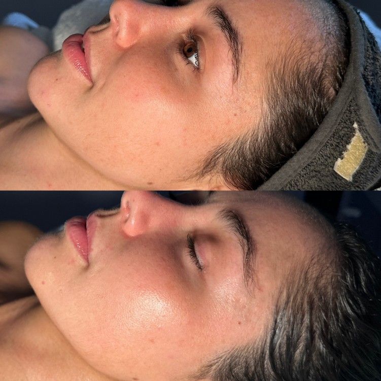 A Before and After Photo of a Woman's Face — SKN Gold Coast in Southport, QLD