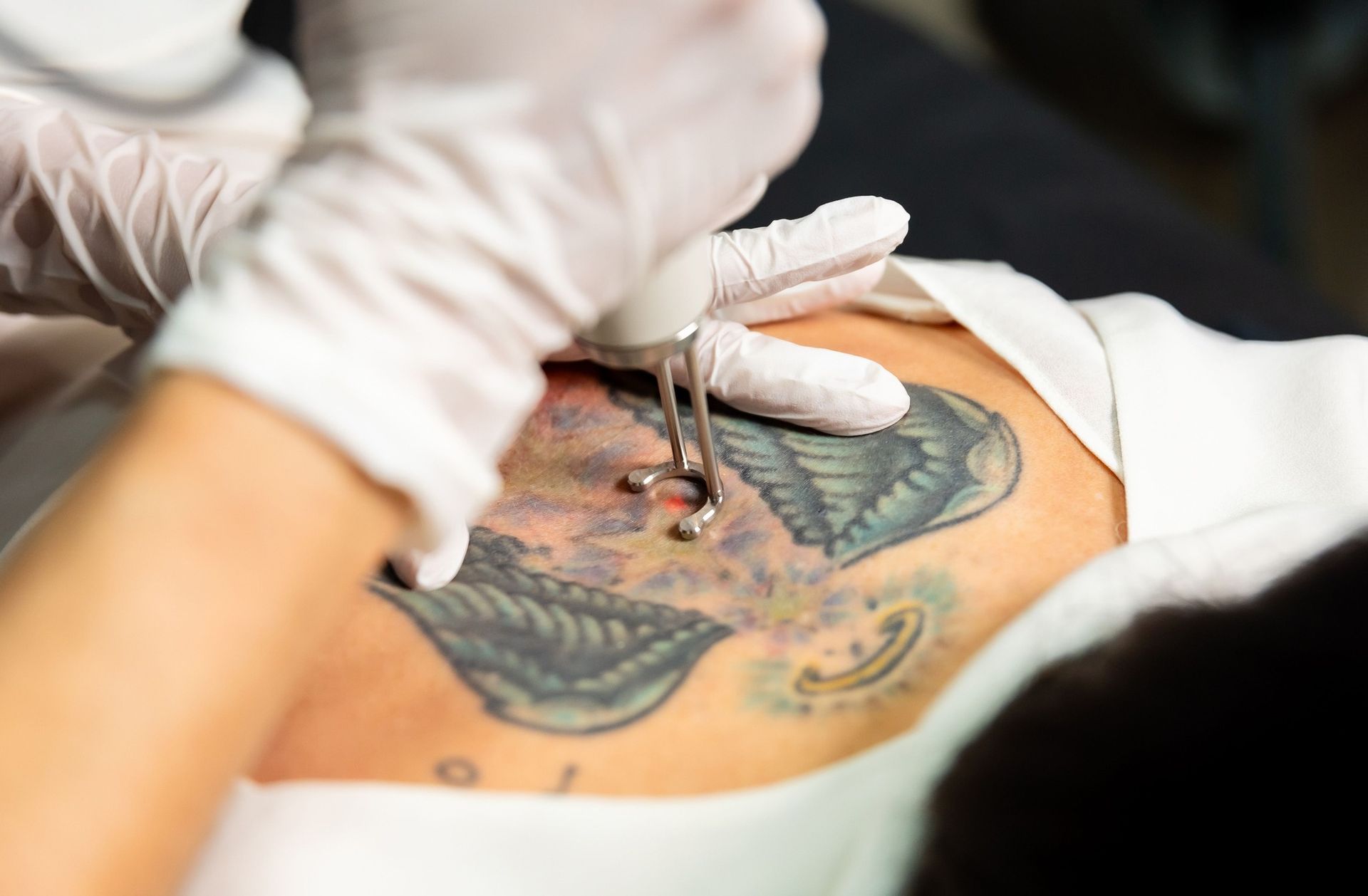 A woman is getting a tattoo removed from her chest.
