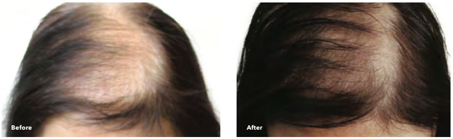 Before and after photos of a person's scalp, showing hair loss improving with treatment.
