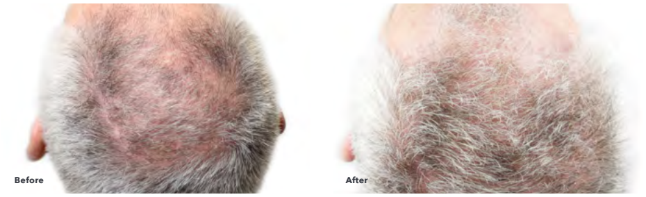 Comparison of a bald scalp before and after hair growth treatment.