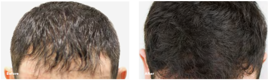 Two photos of a person's head showing hair loss on the left and thicker hair on the right.