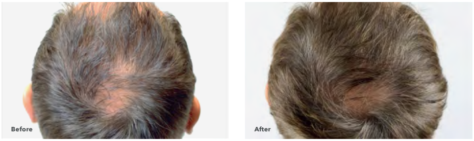 Comparison of male balding scalp before and after treatment, showing hair growth.