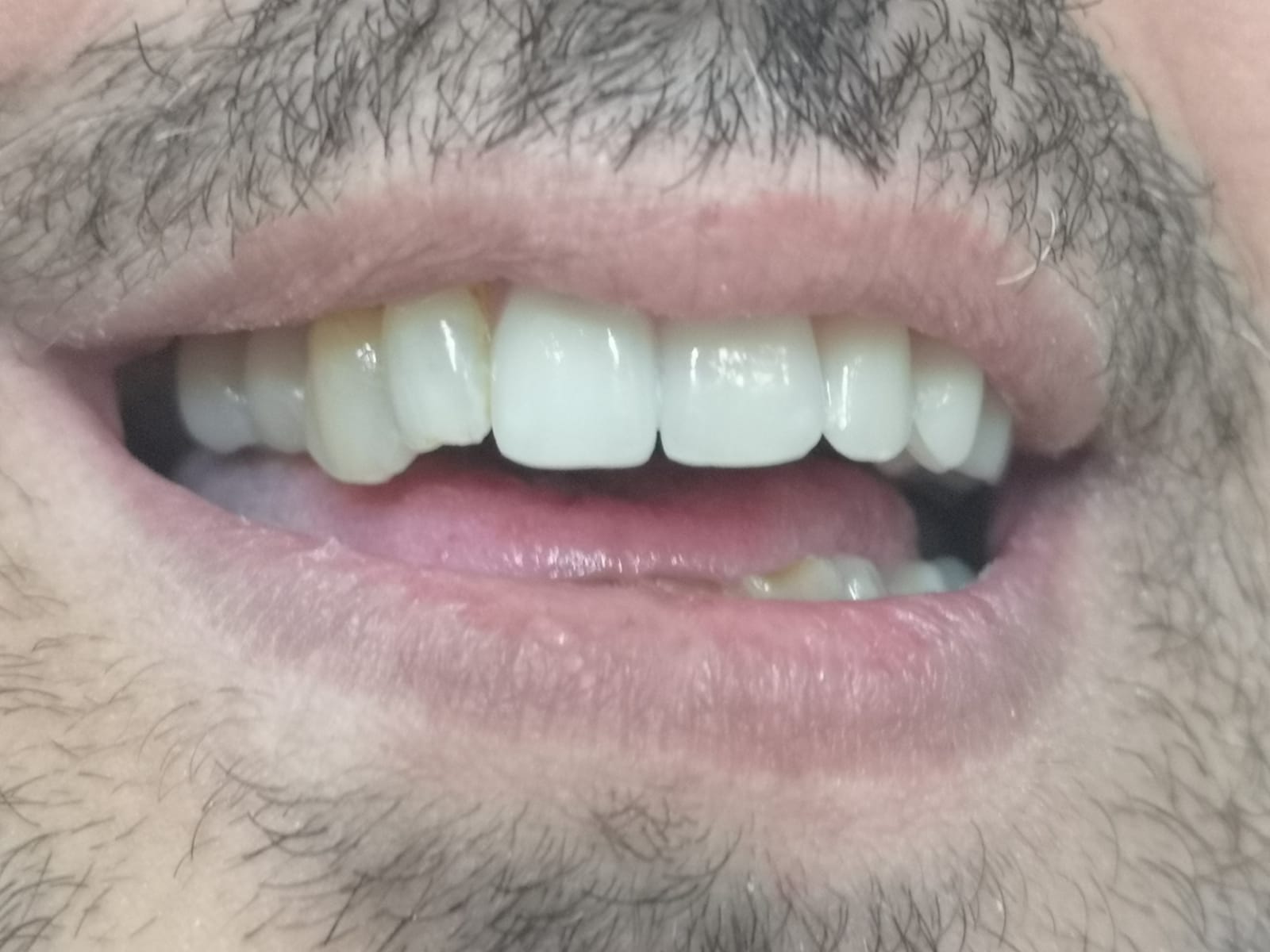 Applicazione protesi mobile, dopo