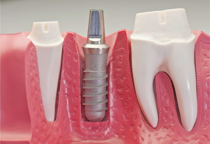 Impianti dentali