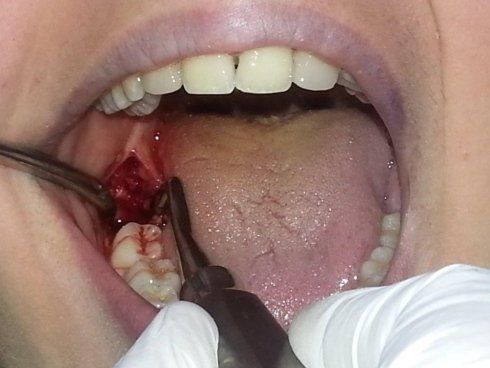 Interventi chirurgici denti