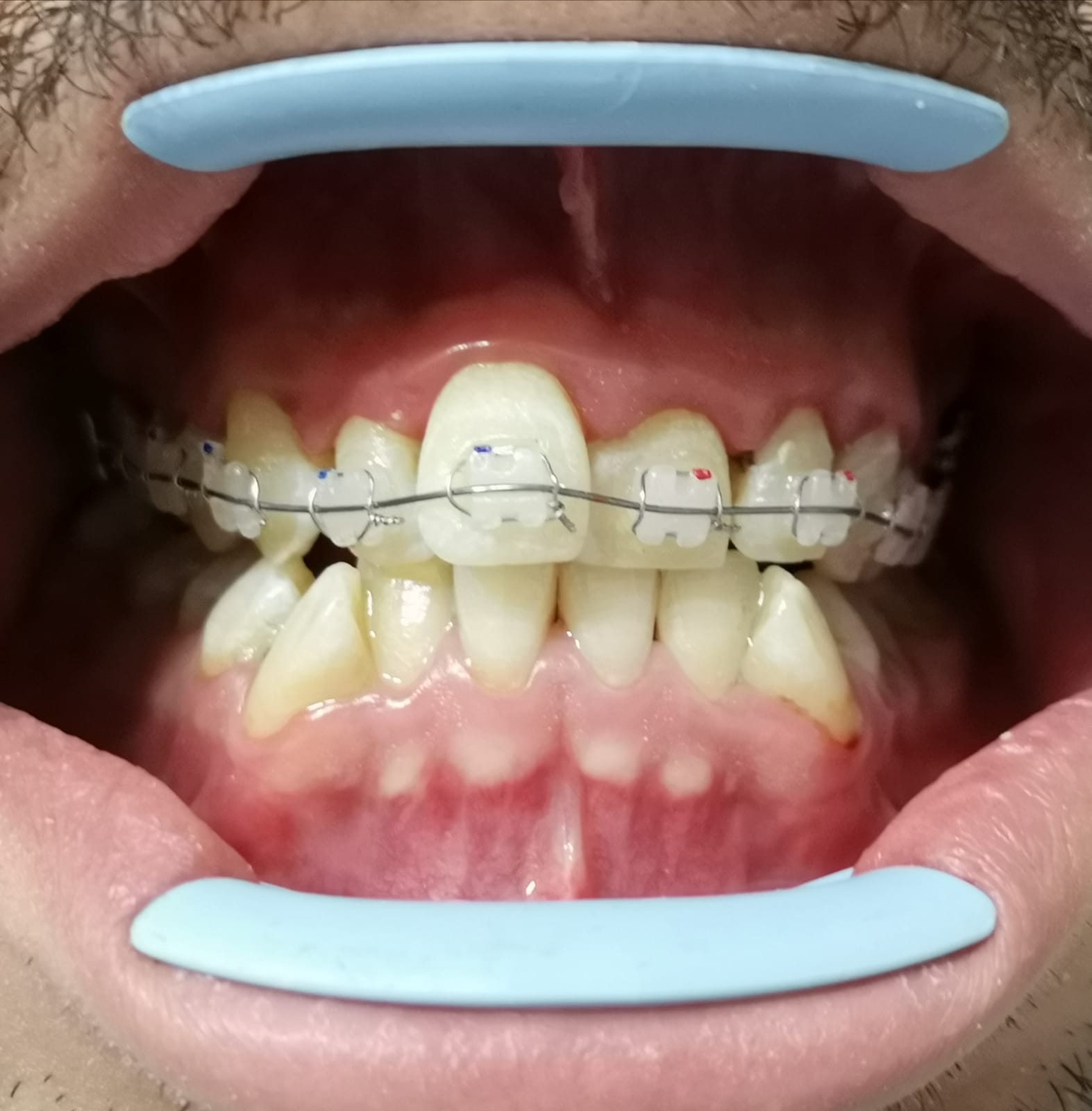 Apparecchio mobile meccanico per riallineamento denti storti
