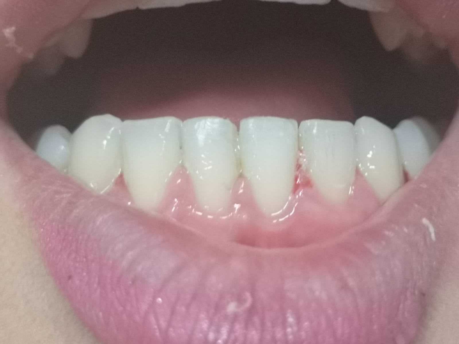 Aarcata dentaria inferiore dopo applocazione apparecchio ortodontico per riallinemanto denti.