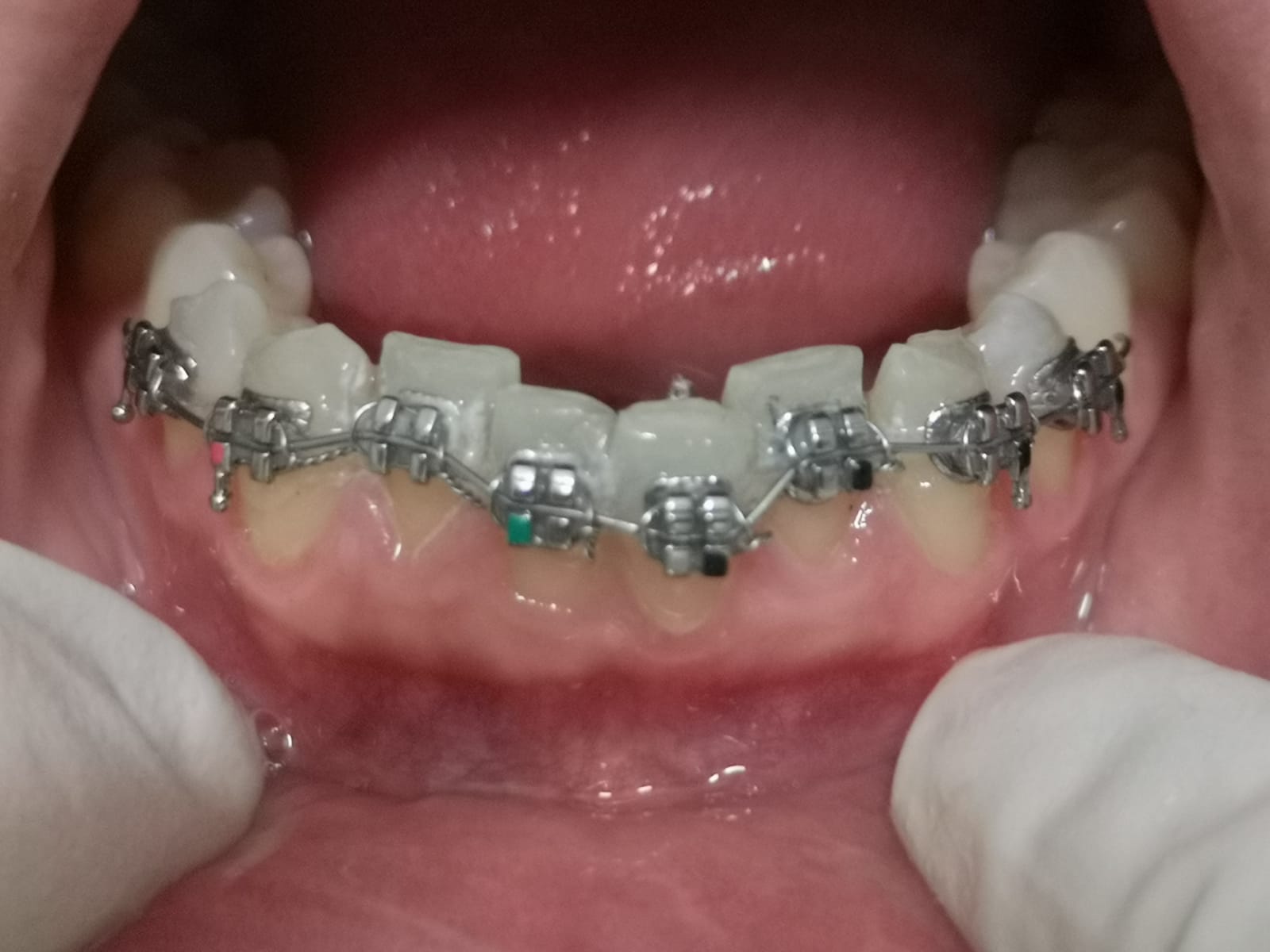 Apparecchio ortodontico per riallinemanto denti arcata dentaria inferiore