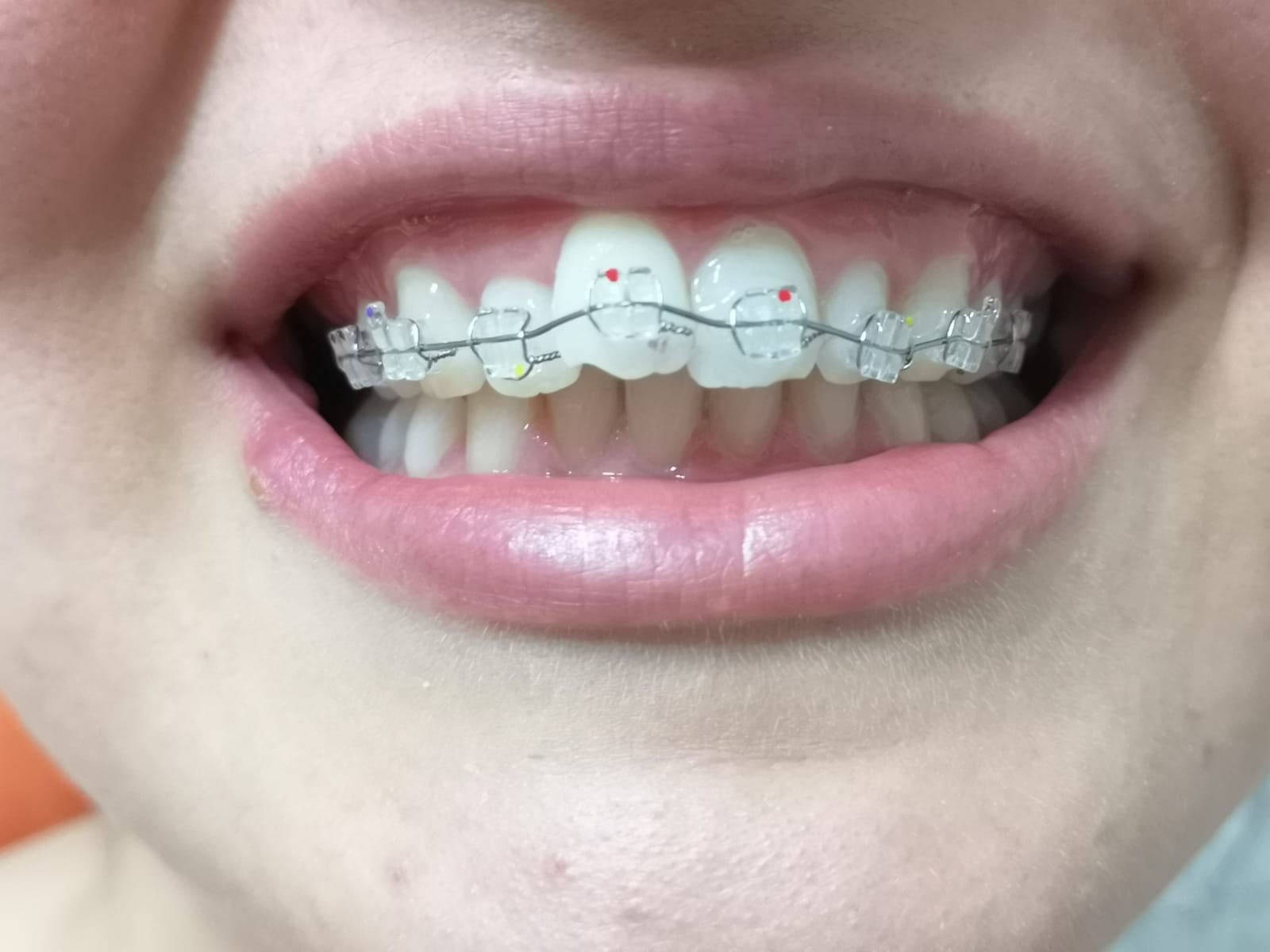 Apparecchio ordotodontico per riallinemanto denti