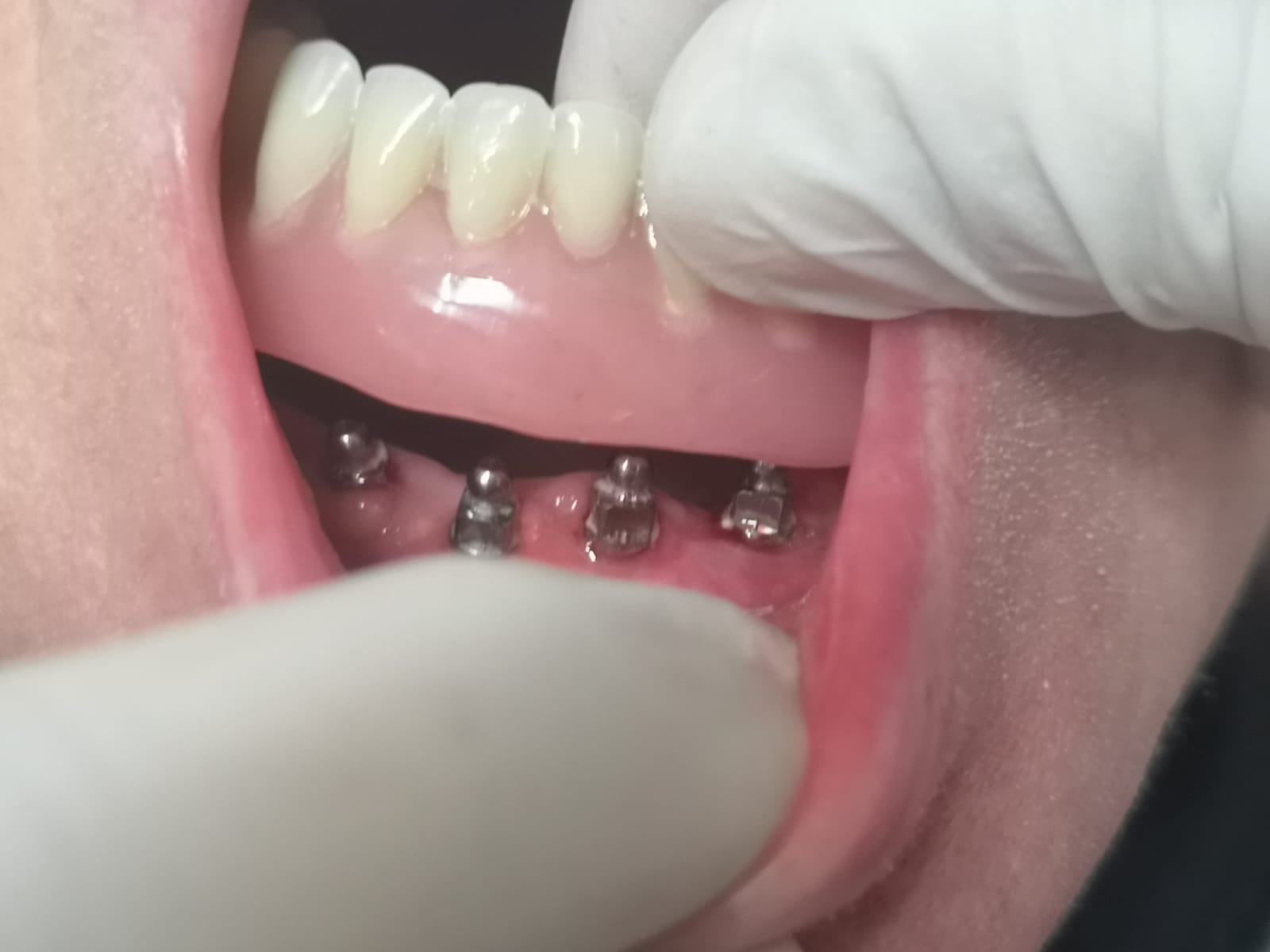 Un dentista inserisce una protesi dentaria superiore completa su impianti dentali nella bocca di un paziente, mostrando un guanto bianco.