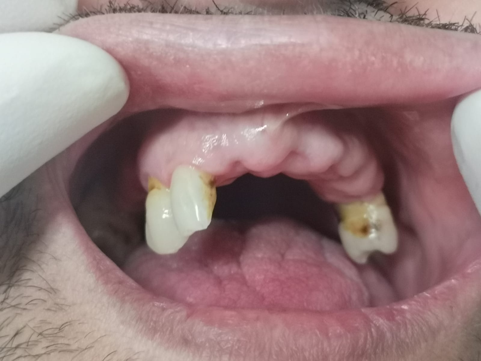 Applicazione protesi mobile, prima