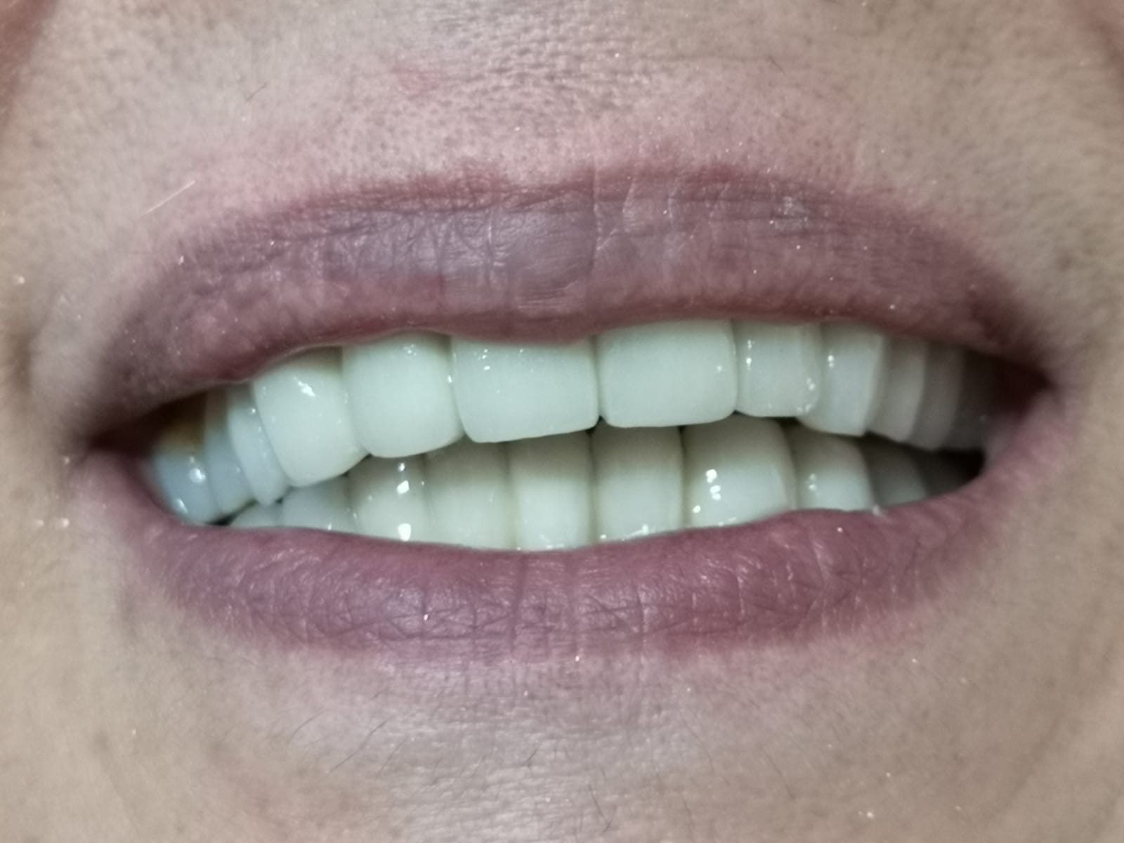 Arcata dentale dopo l'applicazione dell'impianto dentale