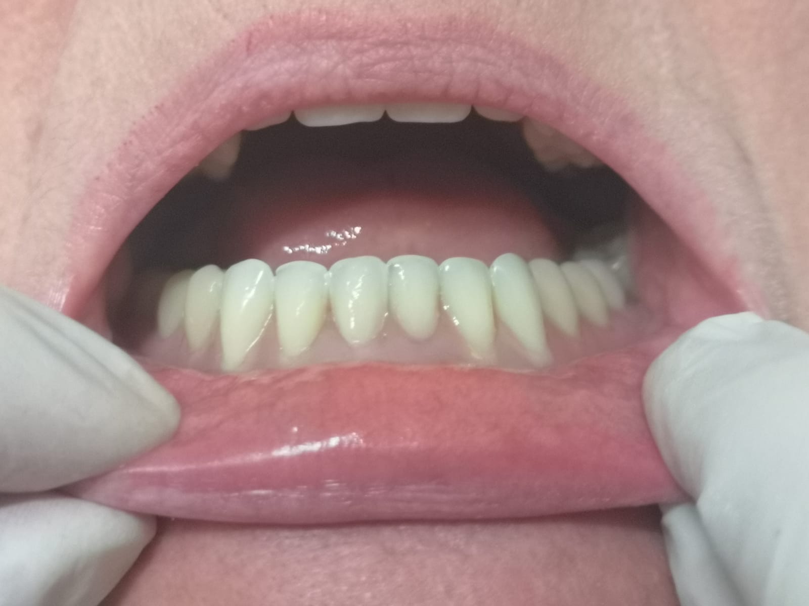 Ripristino arcata dentale applicazione di impianto dentale