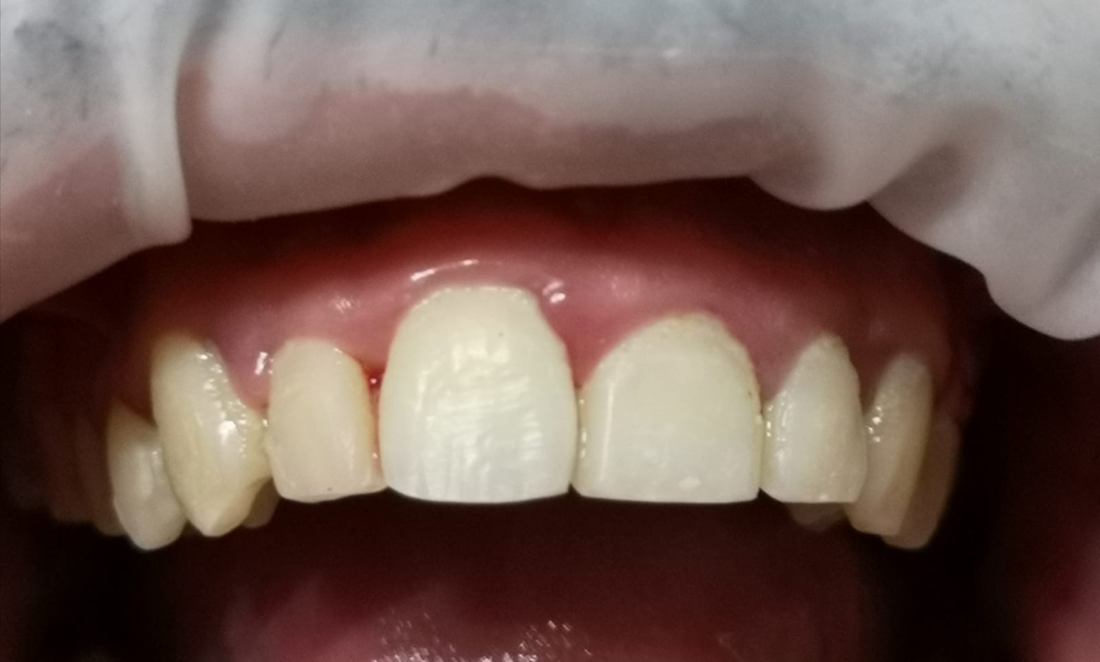 Arcata dentale corretta con apparecchio mobile meccanico per riallineamento denti storti