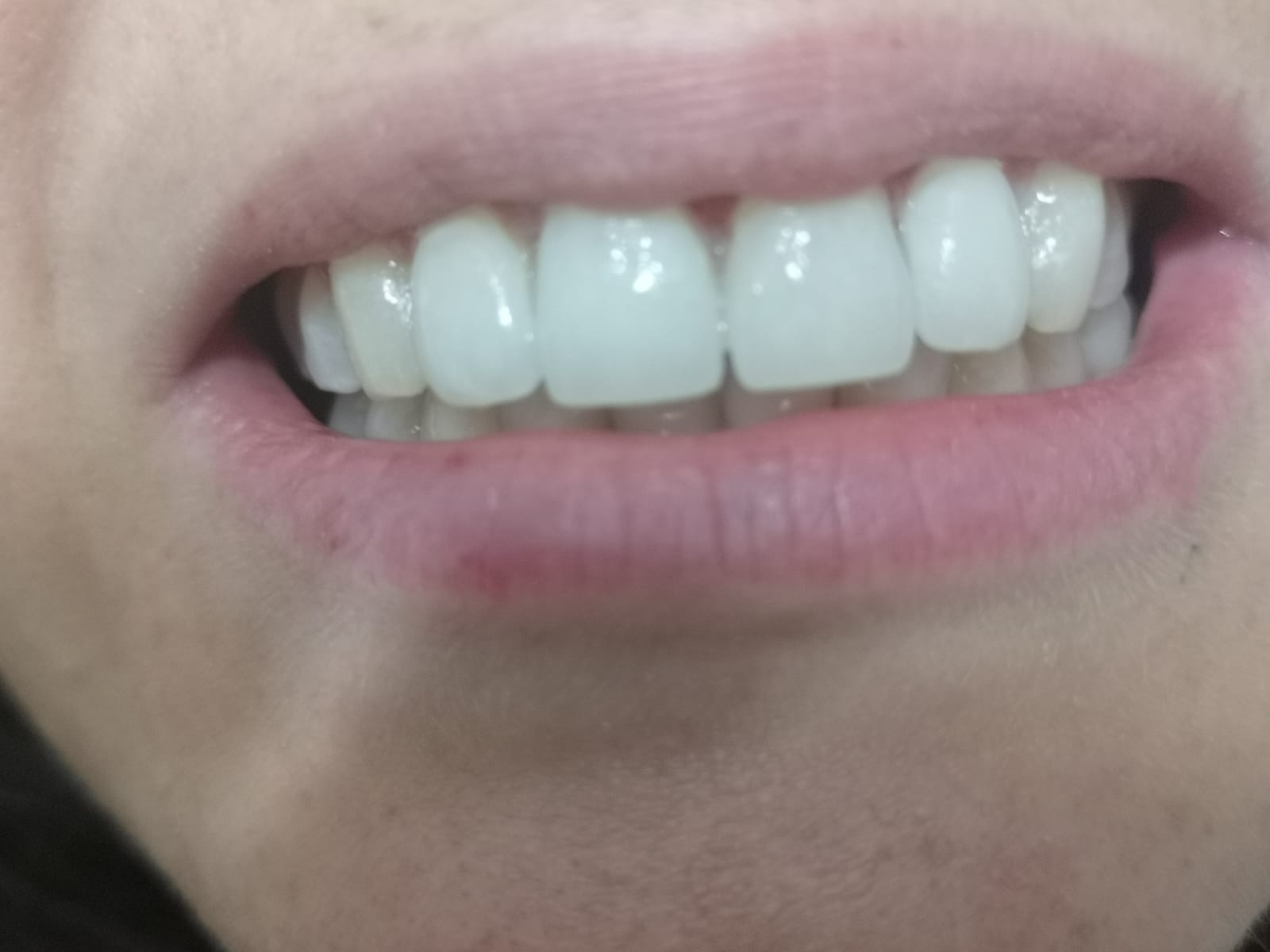 Riallinemanto denti post applicazione apparecchio ortodontico