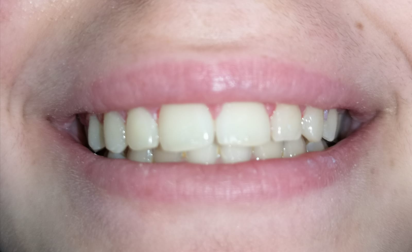 Arcata dentale con riallinemento denti con apparecchio ortodontotico