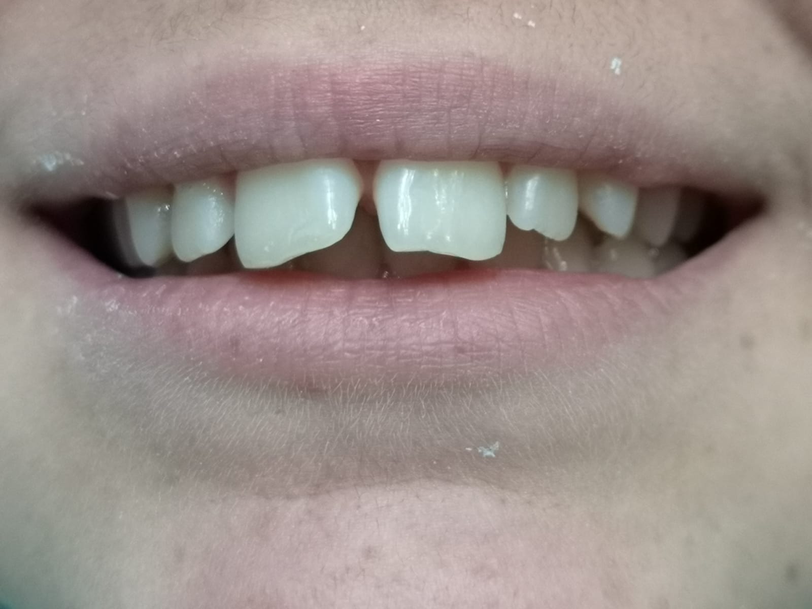 Arcata dentale con denti storti