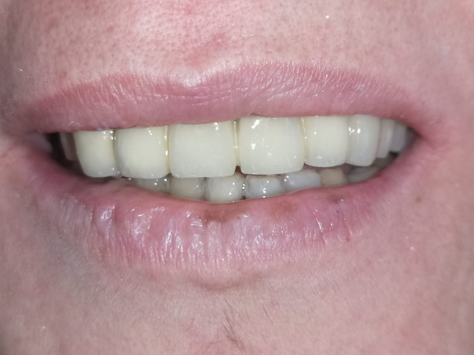 Stato bocca dopo l'applicazione di una protesi fissa dentale