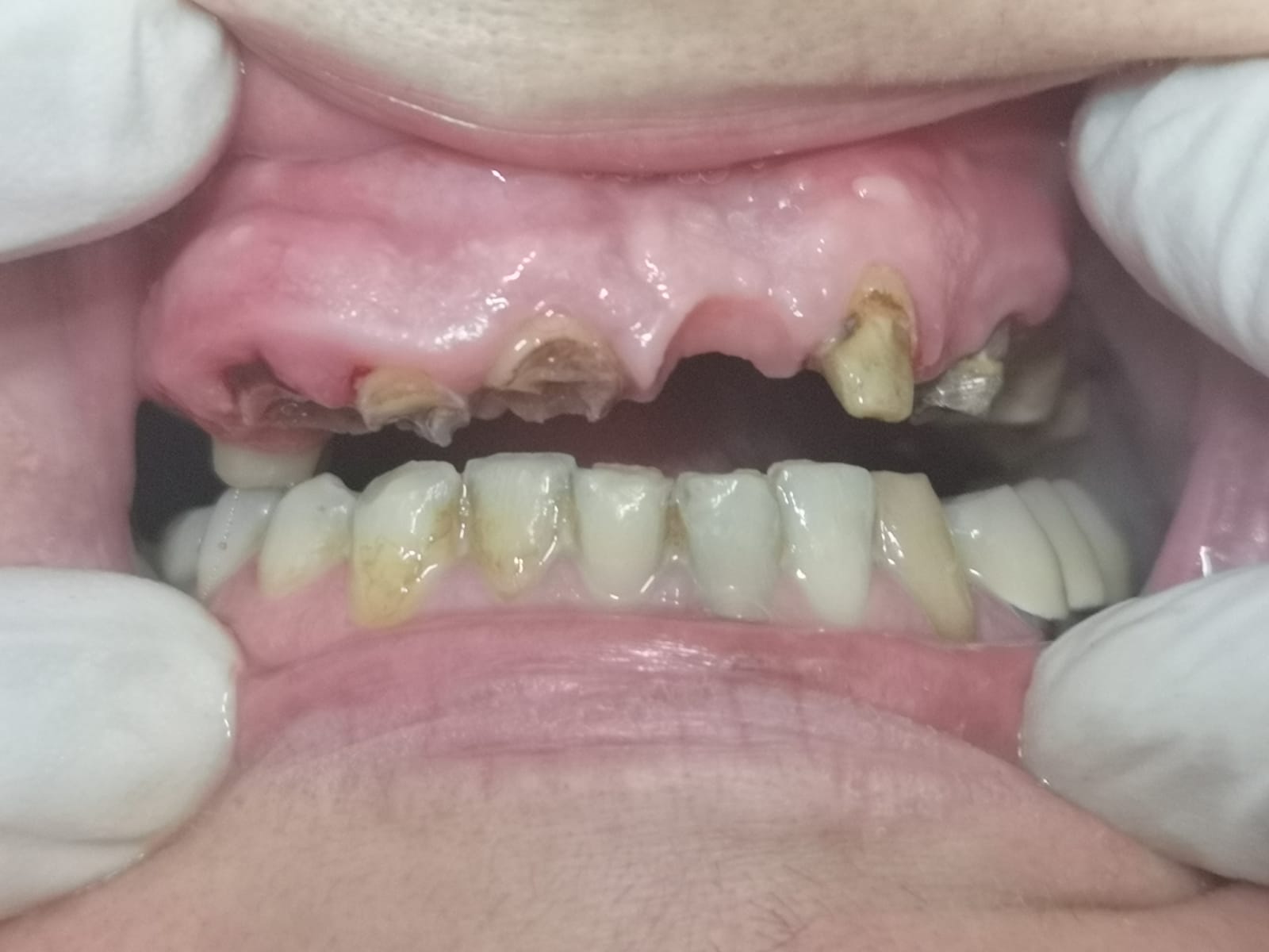 Stato bocca prima dell'applicazione di una protesi fissa dentale