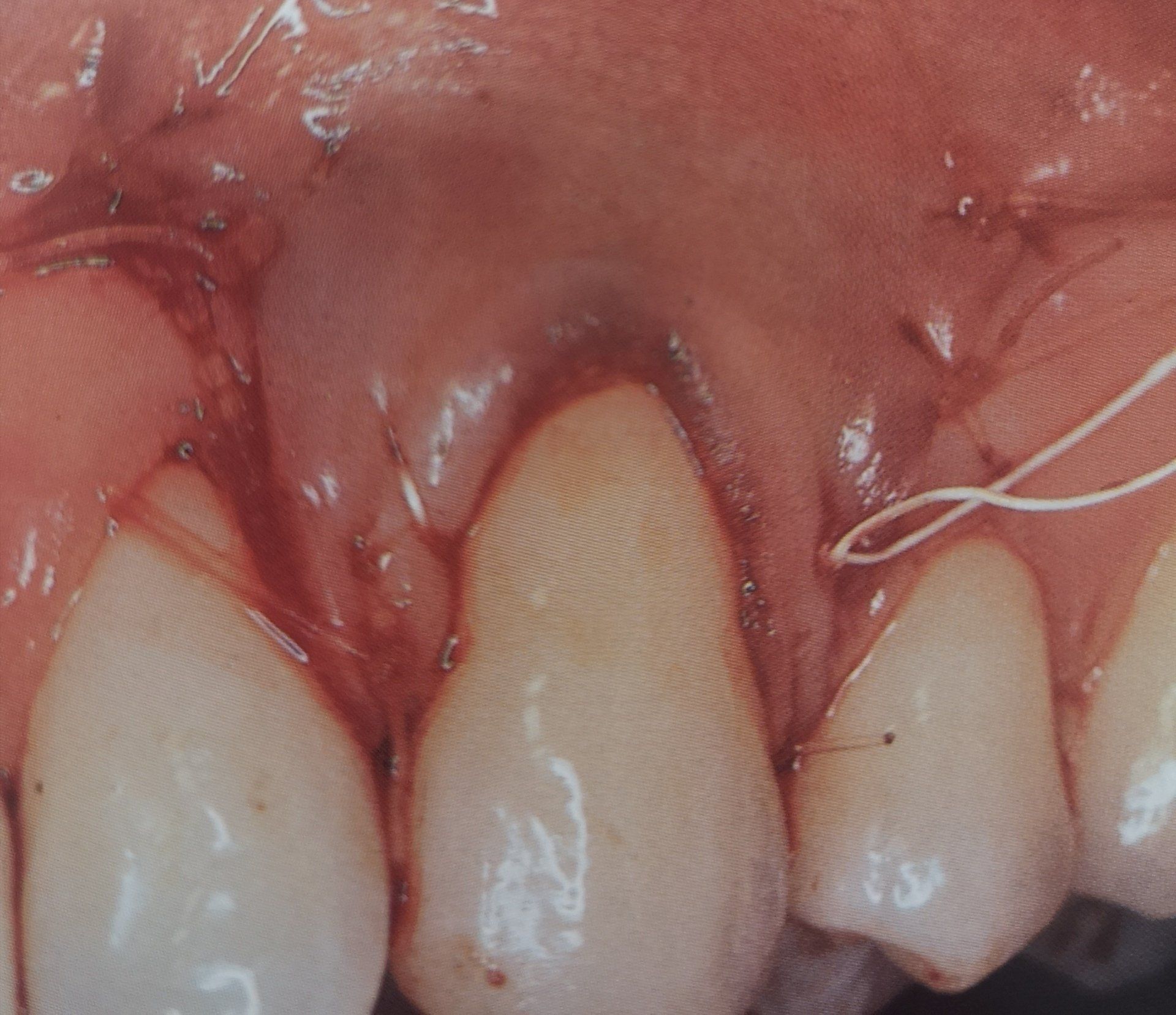 Primo piano del tessuto gengivale suturato attorno a un dente incisivo centrale, probabilmente dopo un intervento odontoiatrico.