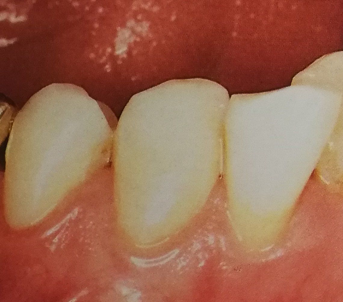 Primo piano di tre denti chiari con un po' di ingiallimento nella parte inferiore, in contrasto con le gengive rosa.