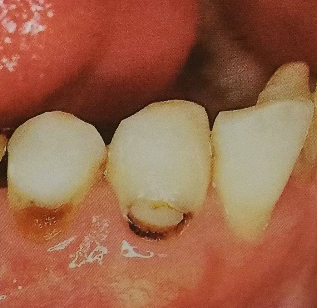 Primo piano dei denti con carie e scolorimento visibili; tonalità marroni e gialle.