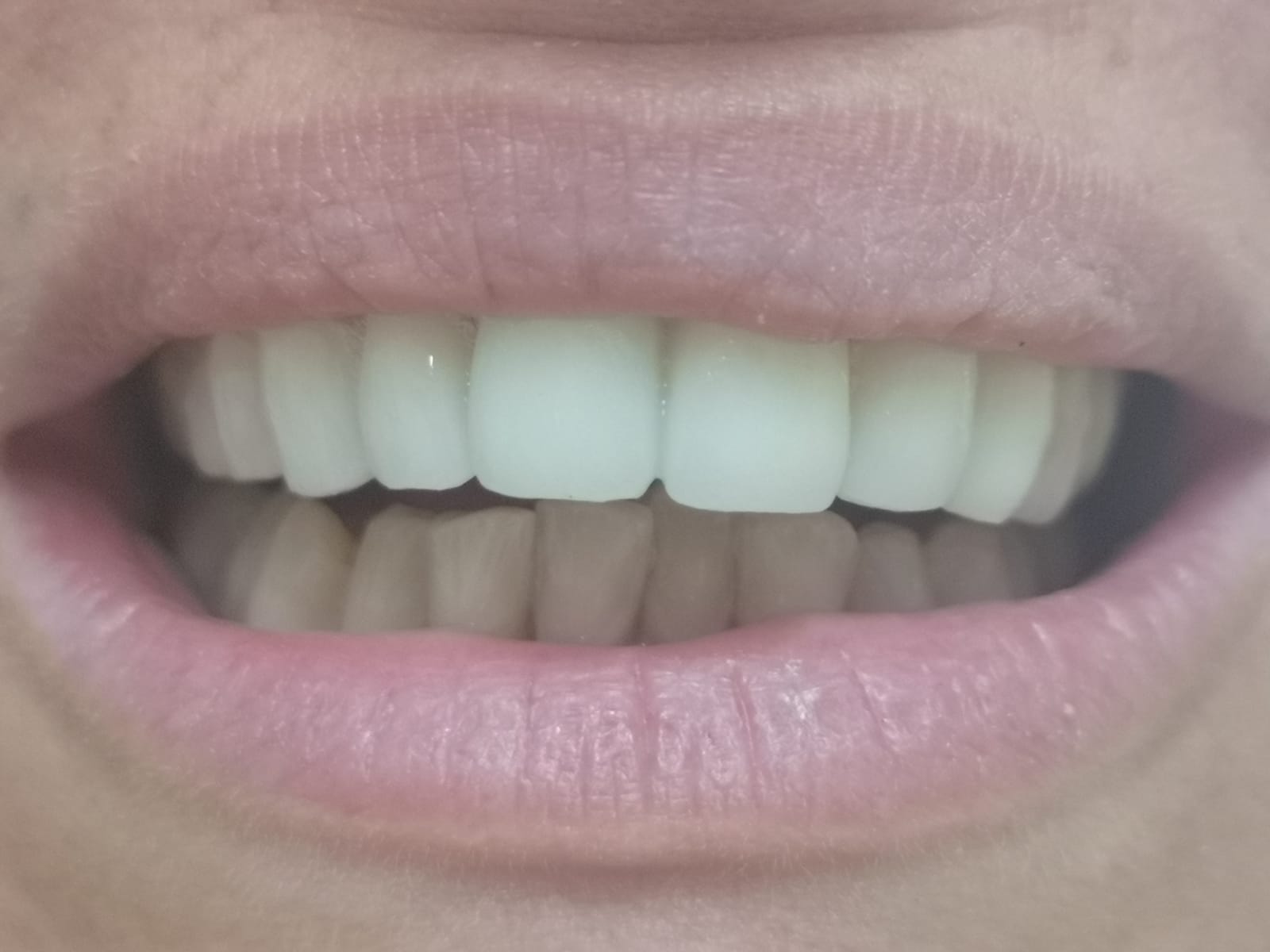 Denti dopo riallineamento con apparecchio ortodontico mobile