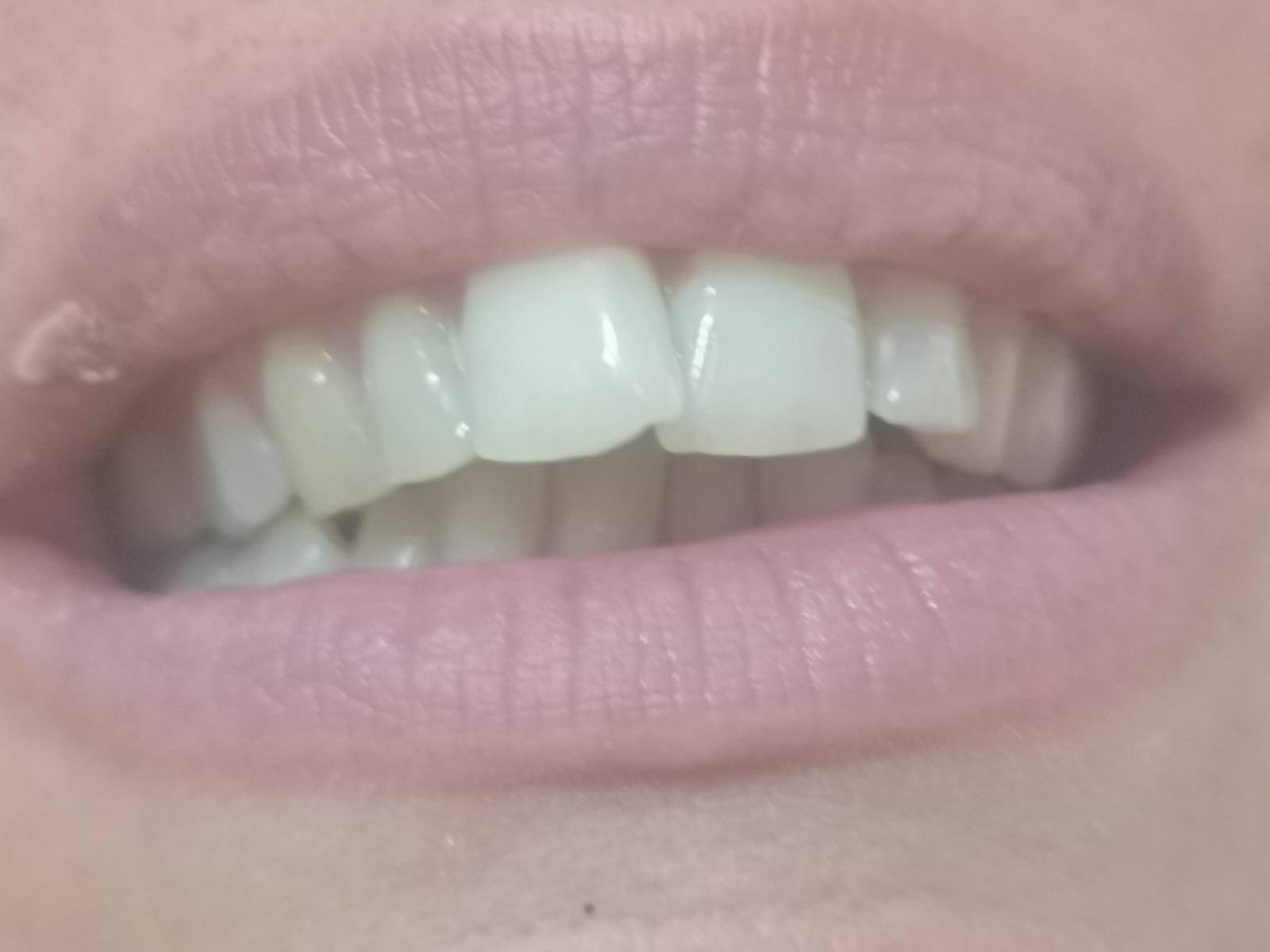 Denti da riallineare con apparecchio ortodontico mobile