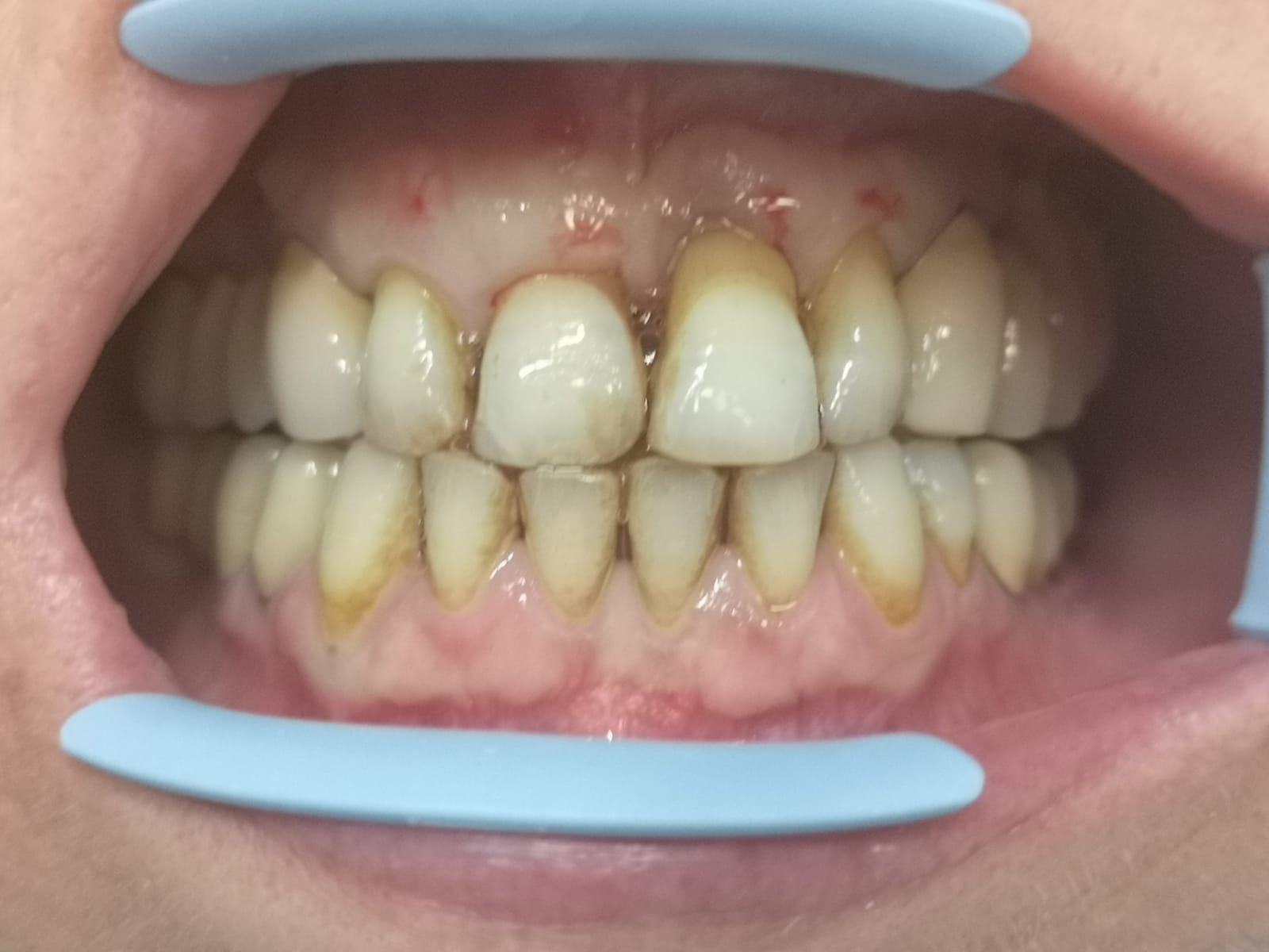 Protesi fisse, prima