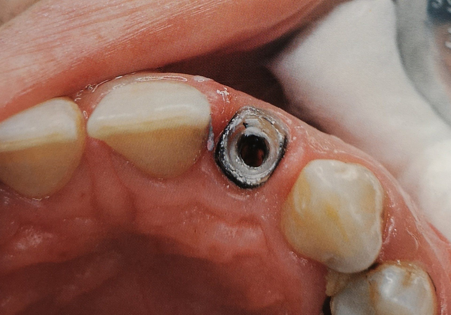 Primo piano della bocca con un impianto dentale in posizione, circondato dai denti. L'impianto è in argento e ha un foro.