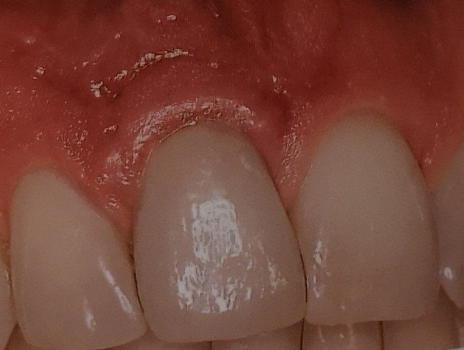 Primo piano di denti con gengive sane e rosa. Un dente presenta una piccola macchia scura.