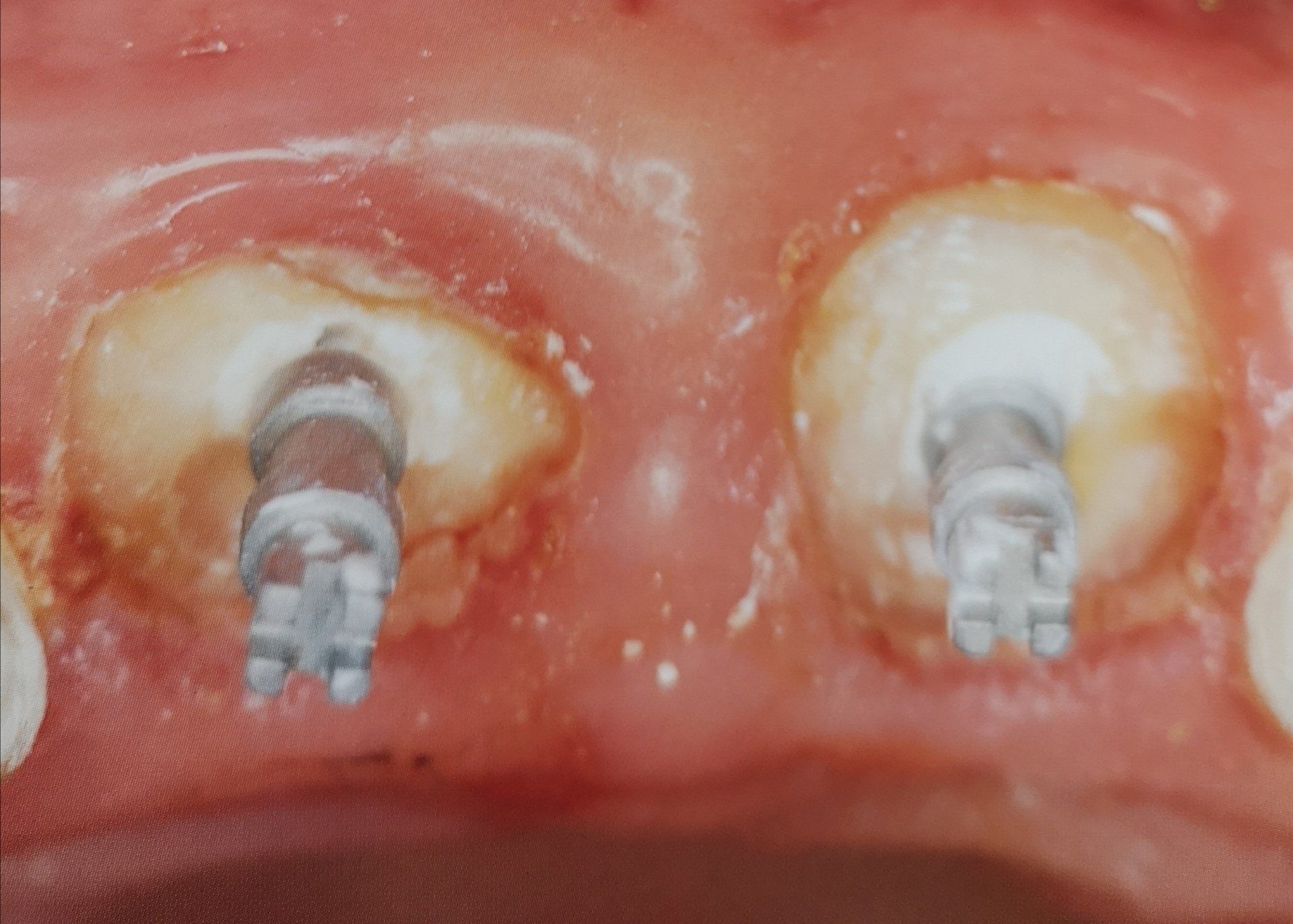 Primo piano di due impianti dentali inseriti nelle gengive, in attesa delle corone.