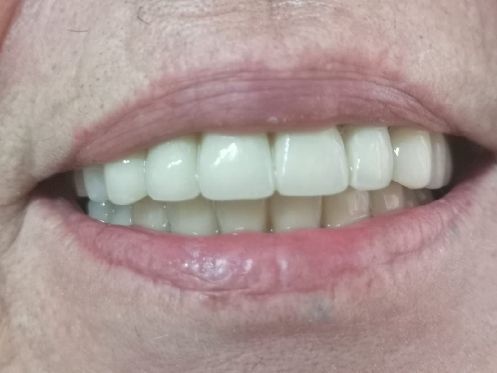 Esempio protesi fissa, dopo