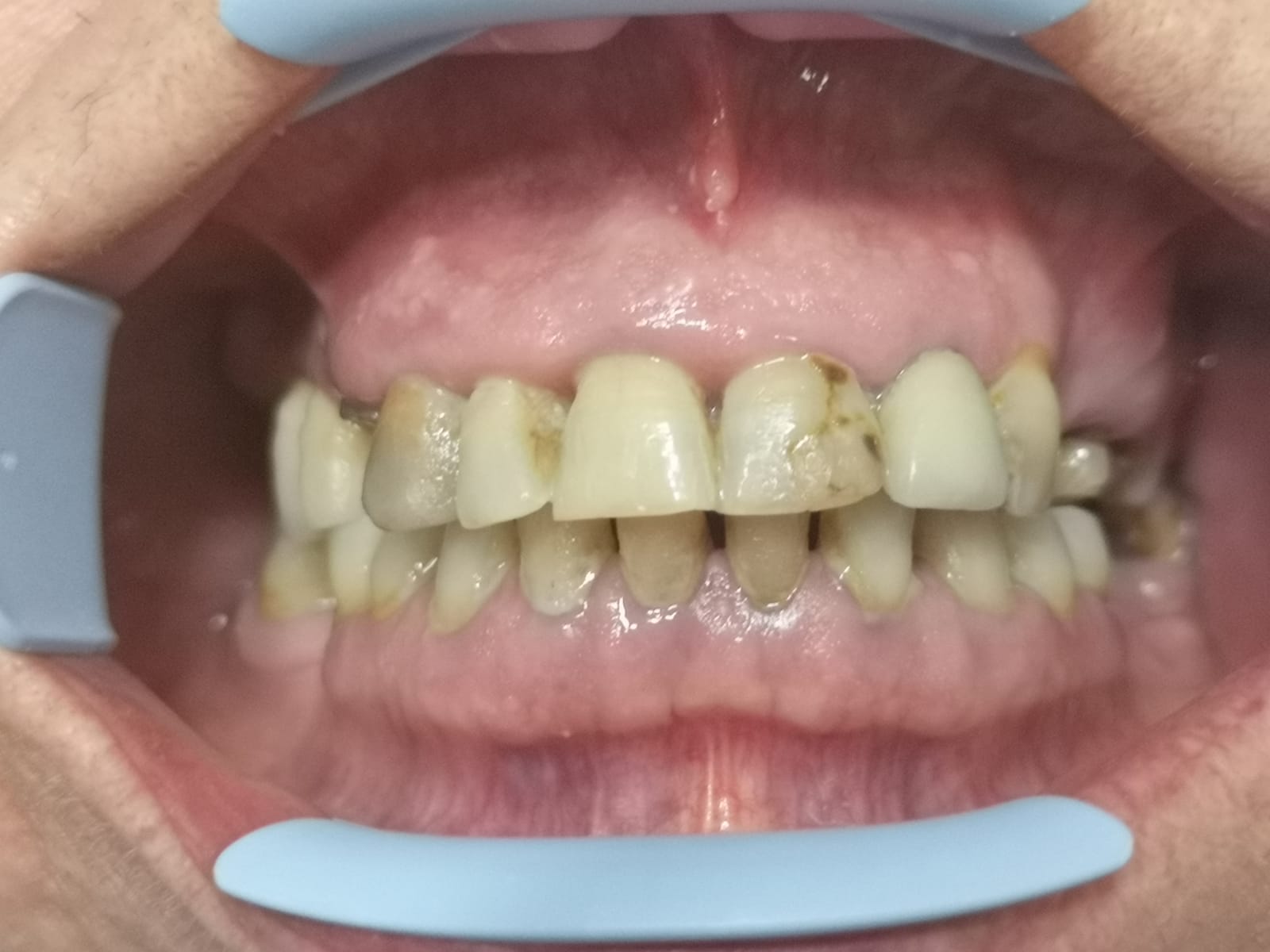 Esempio protesi fissa, prima