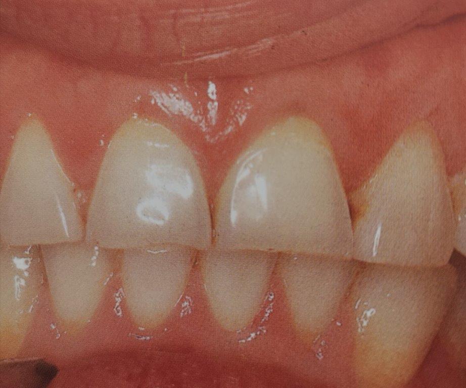 Primo piano dei denti, leggermente ingialliti, con i due denti anteriori leggermente scheggiati.