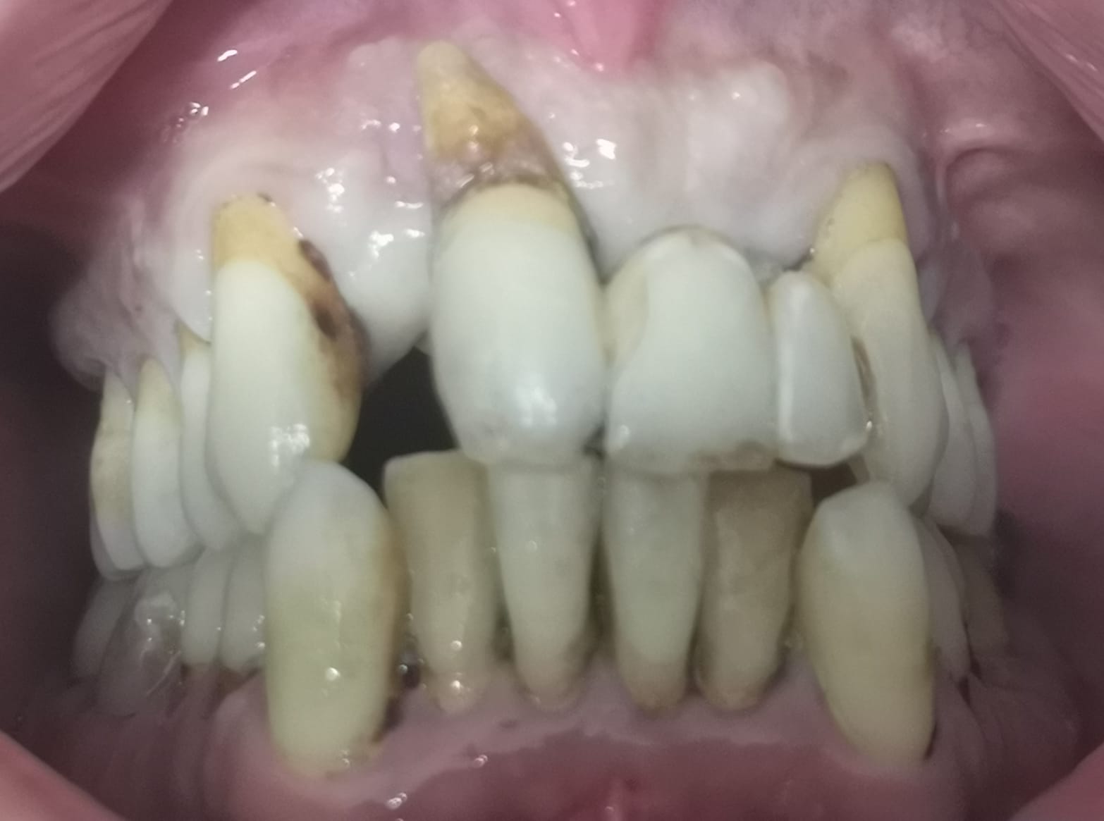 Foto prima dell'applicazione di una protesi fissa